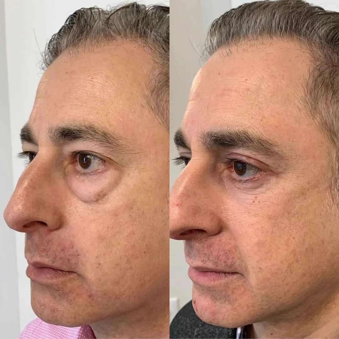 Luméa Labs™ 2-in-1 Red Light Therapy + EMS To Erase Eye Bags