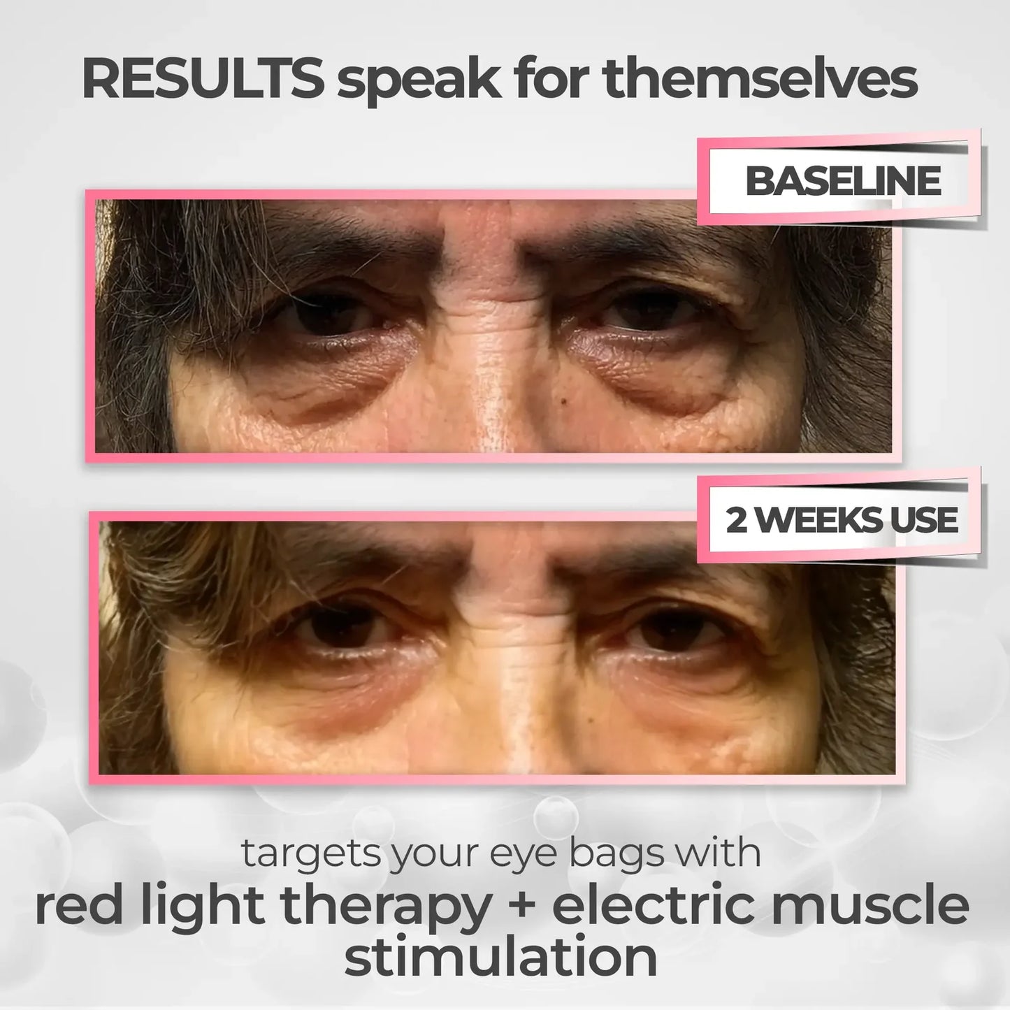 Luméa Labs™ 2-in-1 Red Light Therapy + EMS To Erase Eye Bags