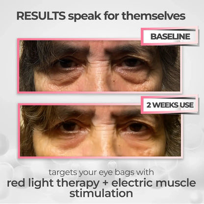 Luméa Labs™ 2-in-1 Red Light Therapy + EMS To Erase Eye Bags