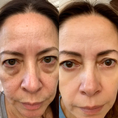 Luméa Labs™ 2-in-1 Red Light Therapy + EMS To Erase Eye Bags