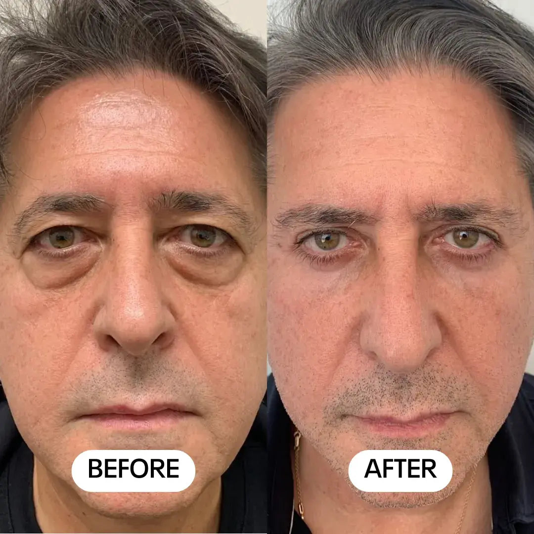 Luméa Labs™ 2-in-1 Red Light Therapy + EMS To Erase Eye Bags