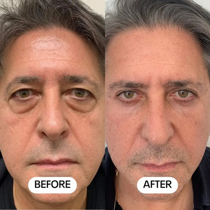 Luméa Labs™ 2-in-1 Red Light Therapy + EMS To Erase Eye Bags