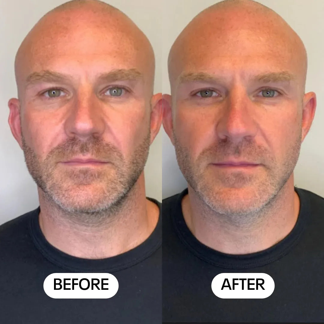 Luméa Labs™ 2-in-1 Red Light Therapy + EMS To Erase Eye Bags