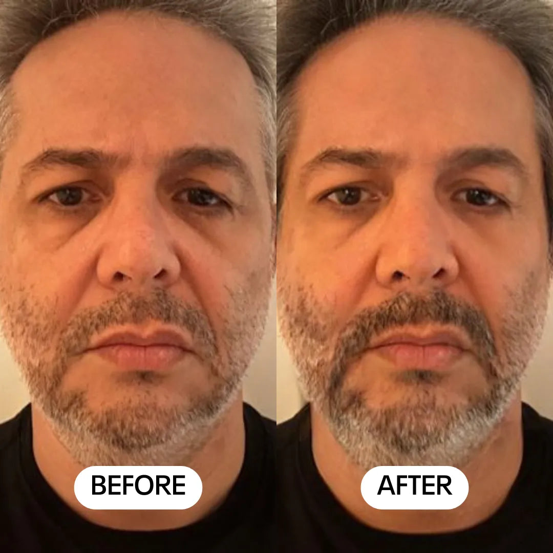 Luméa Labs™ 2-in-1 Red Light Therapy + EMS To Erase Eye Bags